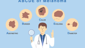 Doctor holding magnifies glass with 5 characteristics of skin damage from cancer cell Illustration about diagnosis and classification of melanoma by use ABCDE letter